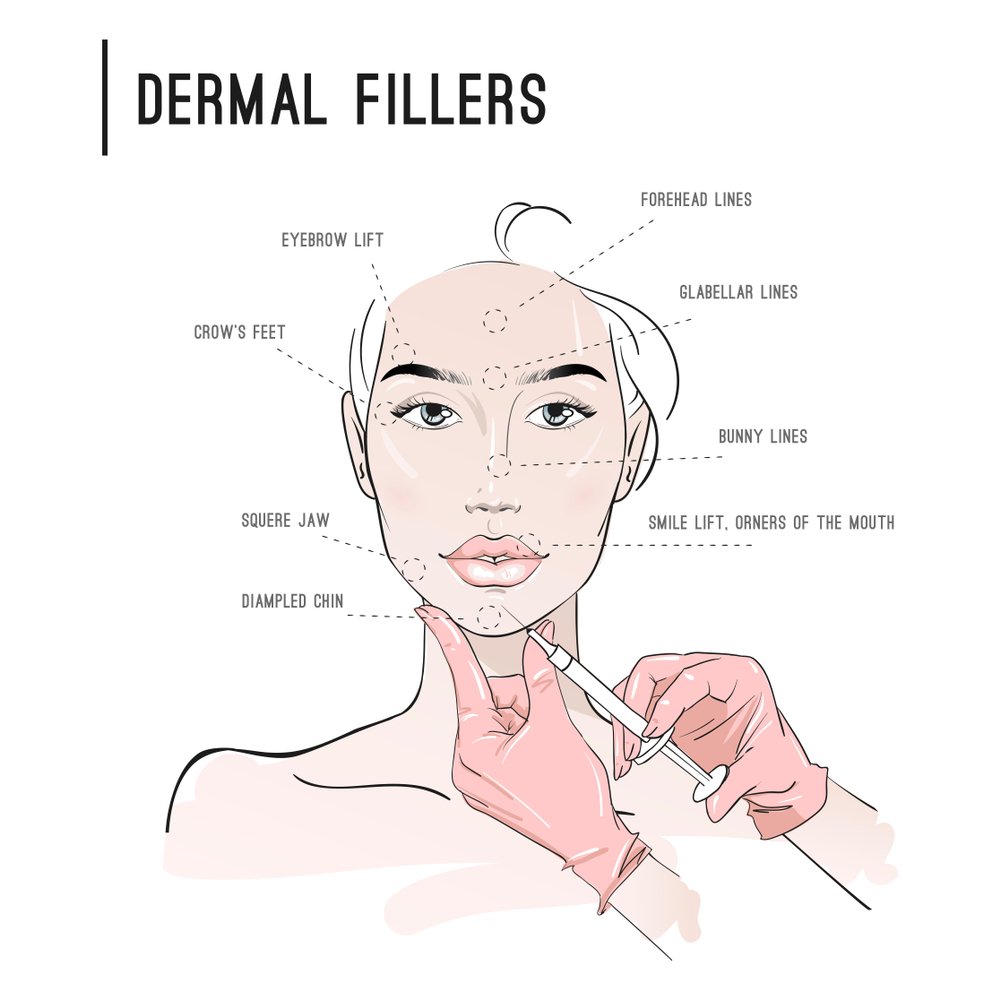 dermal fillers dermal fillers london
