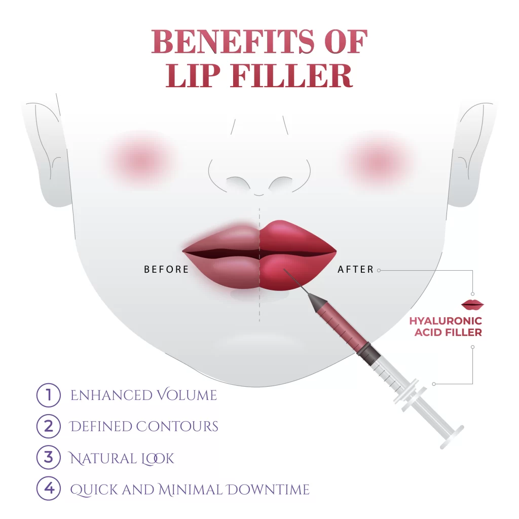 Benefits of lipfiller