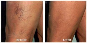 spider-veins02-300x148