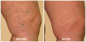 spider-veins04-300x148 (1)