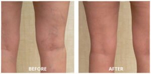 spider-veins05-300x148