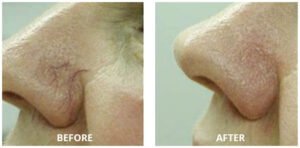 spider-veins06-300x148