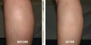 spider-veins07-300x148