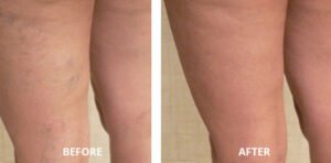 spider-veins08-300x148