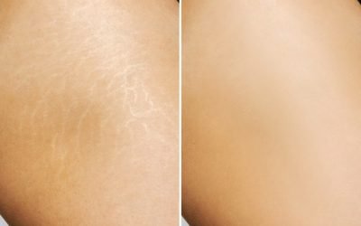 strech-marks-min